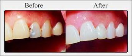 Tooth Colored Filling Comparison